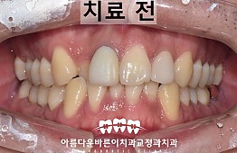 수술전