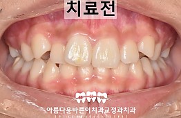 수술전