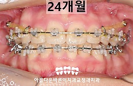 수술후