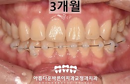 수술후