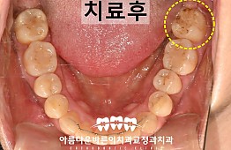 수술후