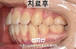 수술후