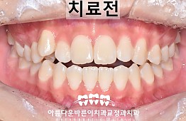 수술전