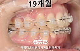 수술후