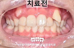 수술전