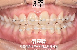 수술후