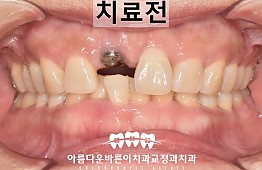 수술전