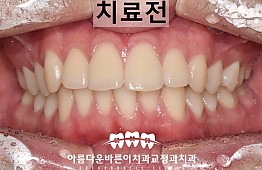 수술전