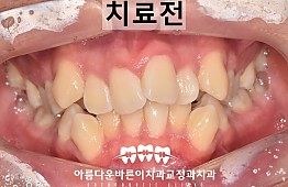 수술전