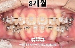 수술후