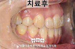 수술후