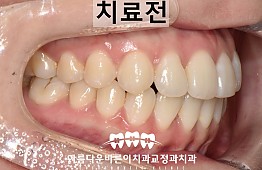 수술전