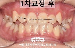 수술후