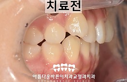 수술전