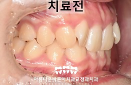 수술전