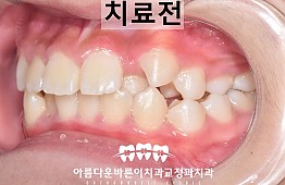 수술전