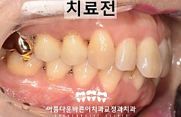 수술전