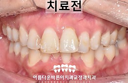 수술전