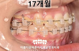 수술후