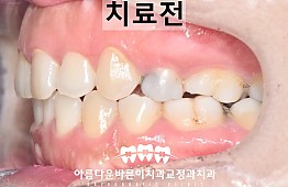 수술전