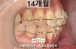 수술후