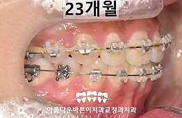 수술후