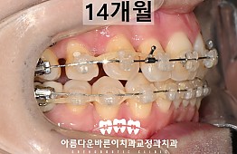 수술후