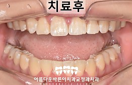 수술후