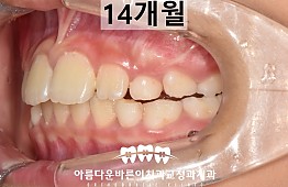 수술후