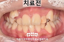 수술전