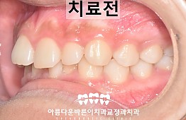 수술전