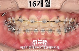 수술후
