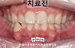 수술전