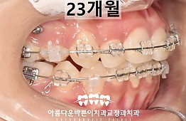 수술후