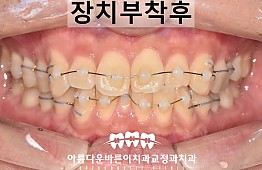 수술후