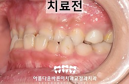 수술전
