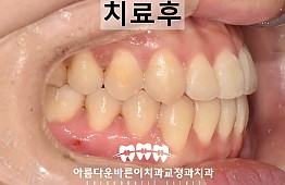 수술후