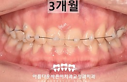 수술후