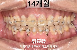수술후