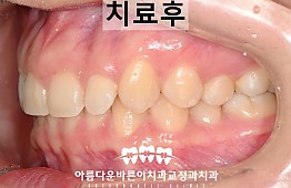 수술후