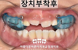 수술후