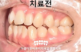 수술전