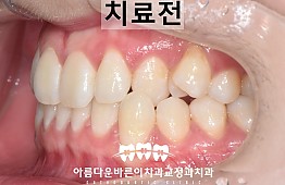 수술전