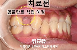 수술전
