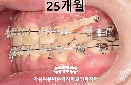 수술후