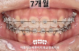 수술후