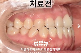 수술전