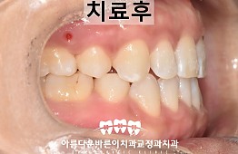 수술후