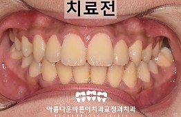 수술전