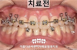 수술전